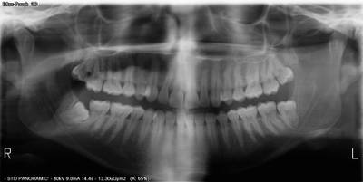 Sample image from Teeth Segmentation on Dental X-ray Images