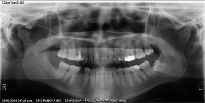 Sample image from Teeth Segmentation on Dental X-ray Images