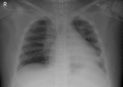 Sample image from ZhangLabData: Chest X-Ray