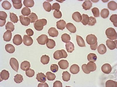 Sample image from Plasmodium Falciparum from Images of Giemsa for Malaria Detection