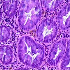 Sample image from EBHI-Seg
