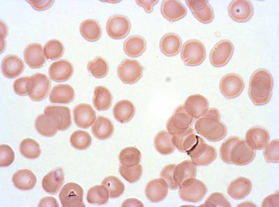 Sample image from Plasmodium Falciparum from Images of Giemsa for Malaria Detection