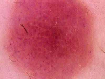 Sample image from Skin Cancer: HAM10000