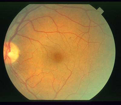 Sample image from STARE