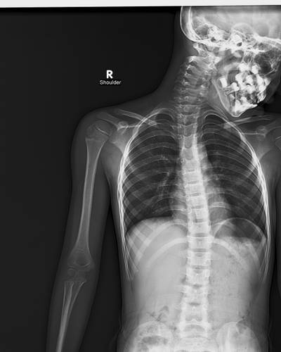Sample image from FracAtlas
