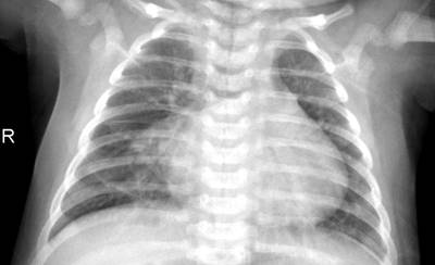 Sample image from ZhangLabData: Chest X-Ray