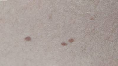 Sample image from Accurate Nevus Shapes