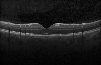 Sample image from ZhangLabData: OCT