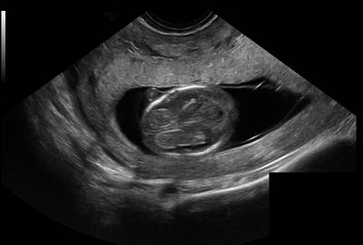 Sample image from Fetal Head UltraSound