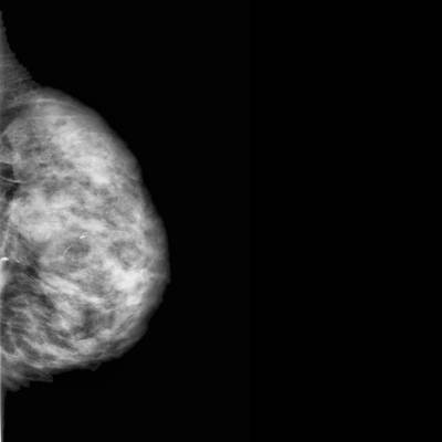 Sample image from CBIS-DDSM