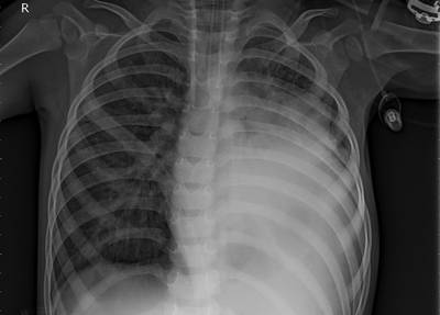 Sample image from ZhangLabData: Chest X-Ray