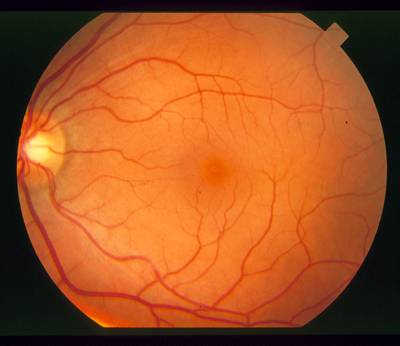Sample image from STARE