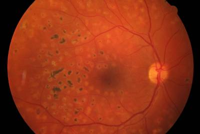 Sample image from High Resolution Fundus
