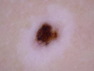 Sample image from Skin Cancer: HAM10000