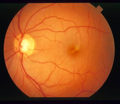 Sample image from STARE