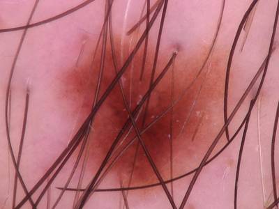 Sample image from Skin Cancer: HAM10000