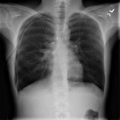 Sample image from SIIM-ACR Pneumothorax Segmentation 2019