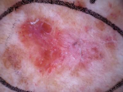 Sample image from Skin Cancer: HAM10000