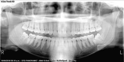 Sample image from Teeth Segmentation on Dental X-ray Images