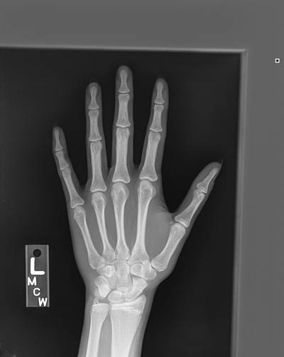 Sample image from RSNA Bone Age 2017