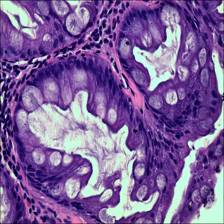 Sample image from EBHI-Seg