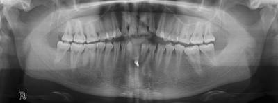 Sample image from Panoramic Dental X-rays