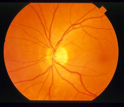 Sample image from STARE