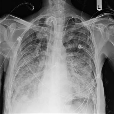 Sample image from SIIM-ACR Pneumothorax Segmentation 2019