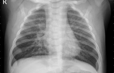 Sample image from ZhangLabData: Chest X-Ray