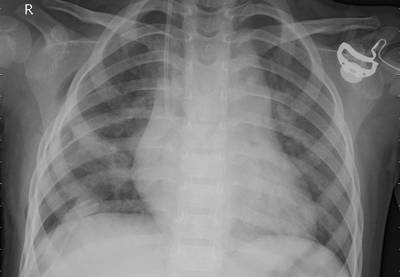 Sample image from ZhangLabData: Chest X-Ray