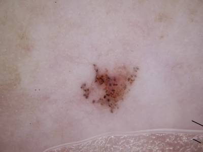 Sample image from Skin Cancer: HAM10000