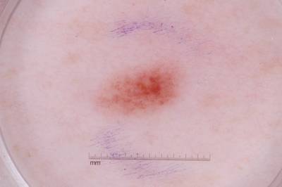 Sample image from ISIC 2017: Part 1 - Lesion Segmentation