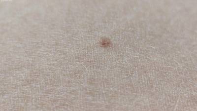 Sample image from Accurate Nevus Shapes