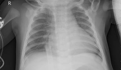 Sample image from ZhangLabData: Chest X-Ray