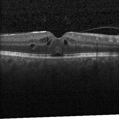 Sample image from Intraretinal Cystoid Fluid