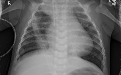 Sample image from ZhangLabData: Chest X-Ray