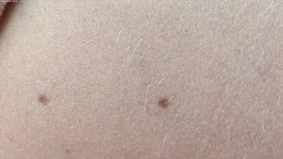Sample image from Accurate Nevus Shapes