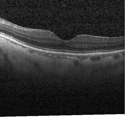 Sample image from ZhangLabData: OCT