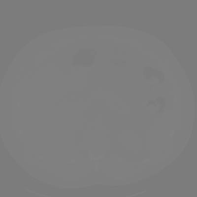 Sample image from DeepLesion