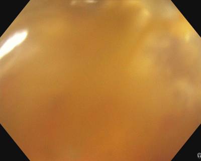 Sample image from PolypGen