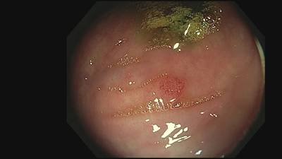 Sample image from Fine Grained Polyp