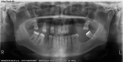 Sample image from Teeth Segmentation on Dental X-ray Images