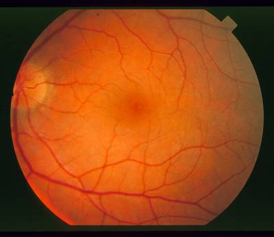 Sample image from STARE