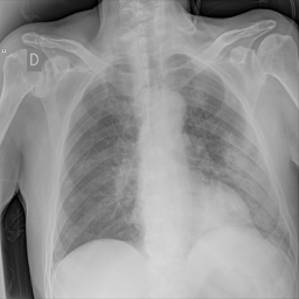 Sample image from COVID-19