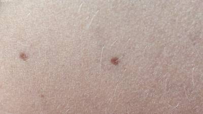Sample image from Accurate Nevus Shapes
