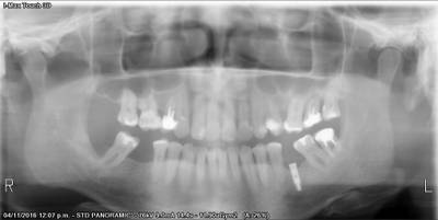 Sample image from Teeth Segmentation on Dental X-ray Images