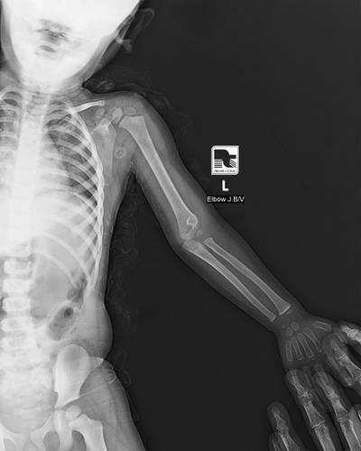 Sample image from FracAtlas