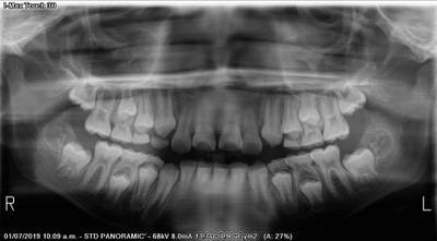 Sample image from Teeth Segmentation on Dental X-ray Images