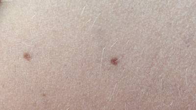 Sample image from Accurate Nevus Shapes