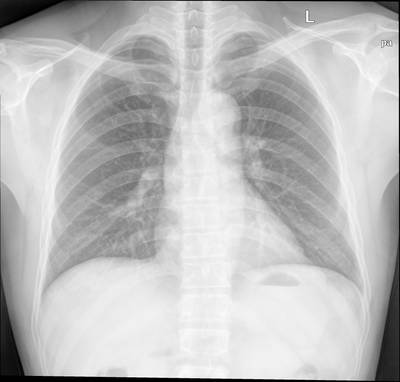 Sample image from Chest Xray Masks and Labels